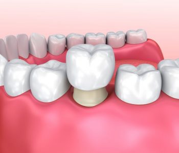 dental-crown-process
