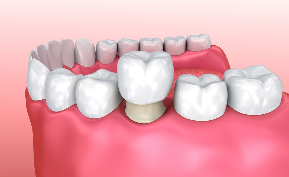dental-crown-process